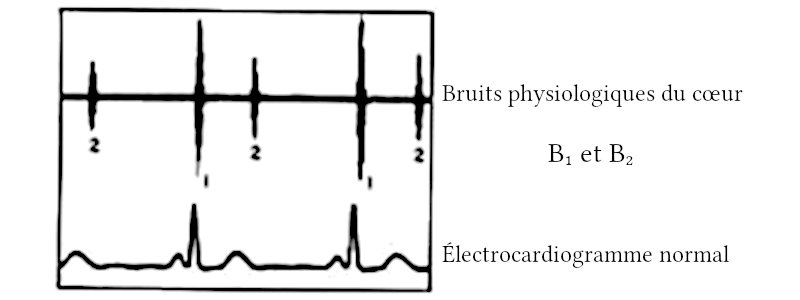 Bruits du cœur