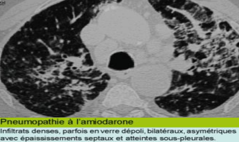 Pneumopathie à l’amiodarone