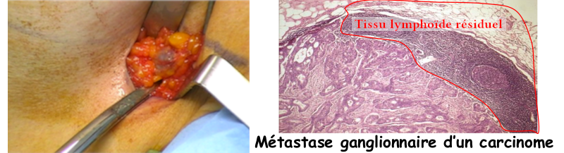 Biopsie ganglionaire