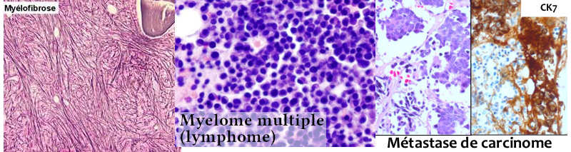 Biopsies médulaires pathologiques